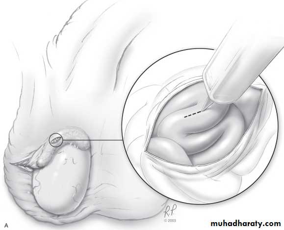 MALE INFERTILITY