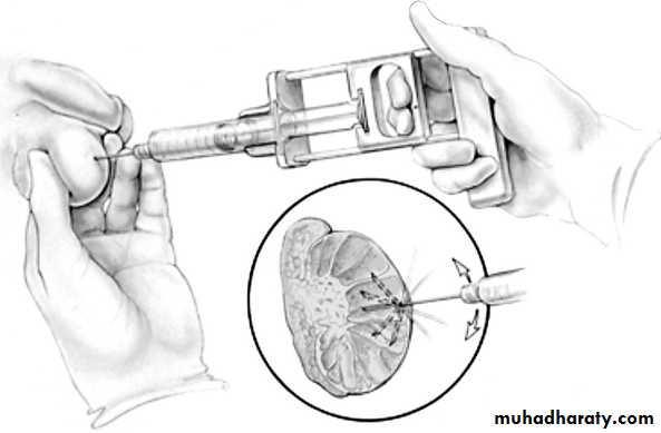 MALE INFERTILITY