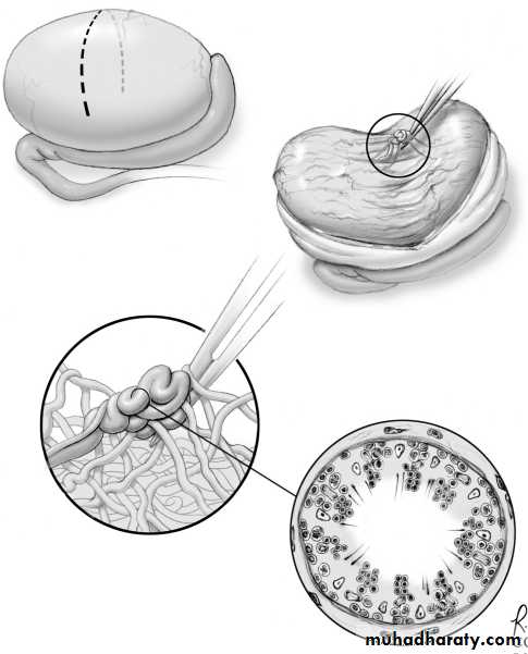MALE INFERTILITY