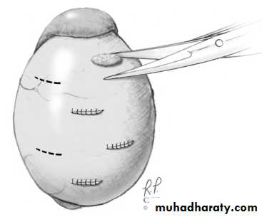 MALE INFERTILITY