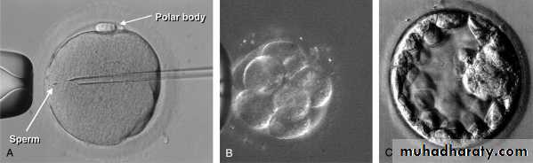MALE INFERTILITY