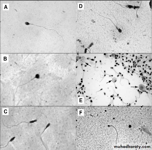 MALE INFERTILITY