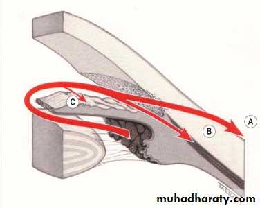 Glaucoma