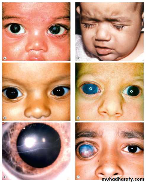Glaucoma