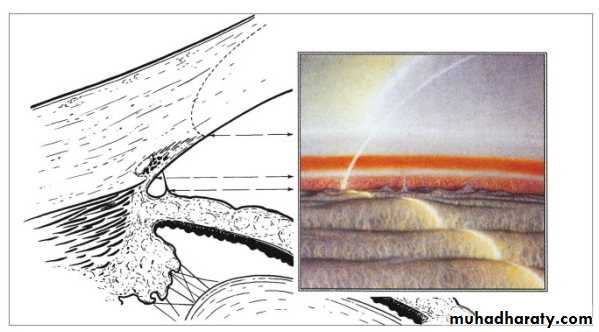 Glaucoma