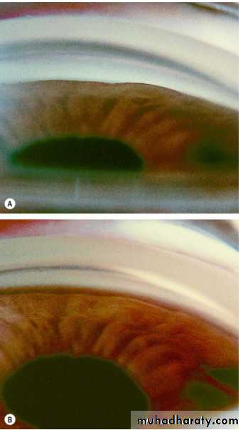 Glaucoma