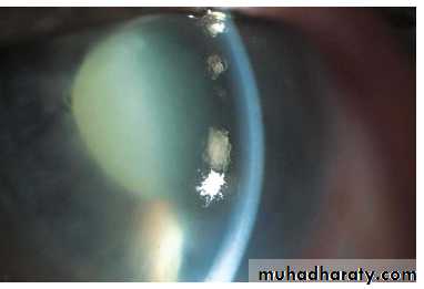 Glaucoma