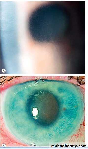 Glaucoma