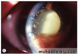 Glaucoma