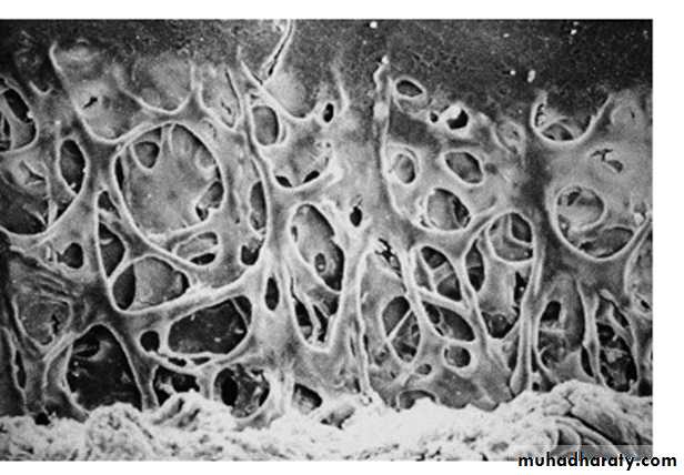 Glaucoma