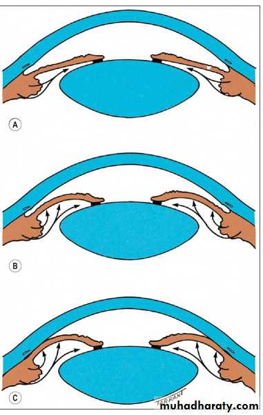 Glaucoma