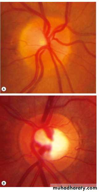 Glaucoma