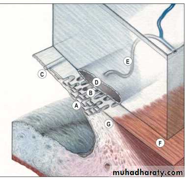 Glaucoma