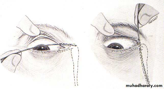 LACRIMAL SYSTEM