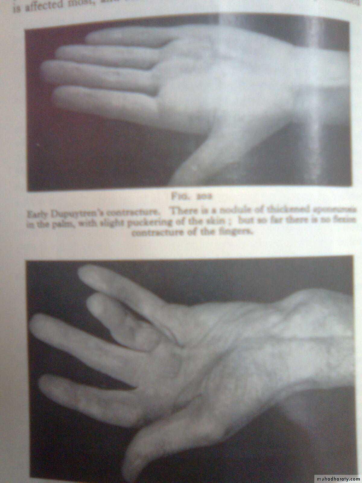 MUSCULOSKELETAL MANIFESTATION