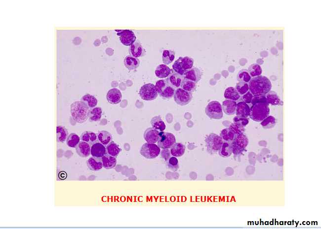 chronic myleoid leukaemia