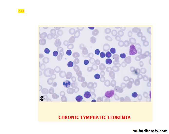 chronic myleoid leukaemia