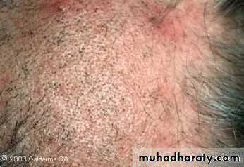 Diseases of the Hair