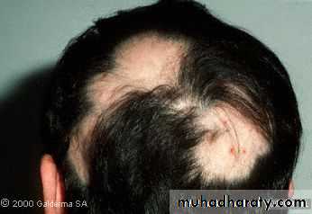 Diseases of the Hair