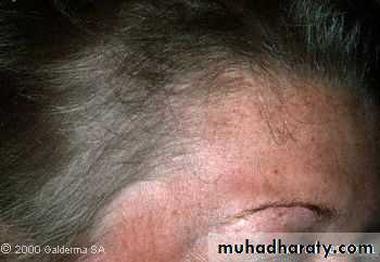 Diseases of the Hair