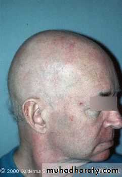 Diseases of the Hair