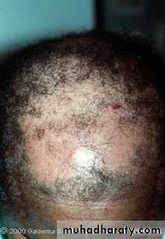 Diseases of the Hair