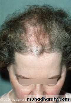 Diseases of the Hair