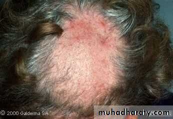 Diseases of the Hair