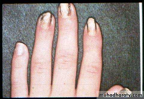 Fungal Infections