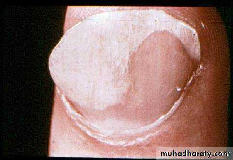 Fungal Infections