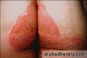 Fungal Infections