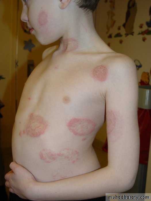 Fungal Infections