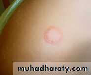 Fungal Infections