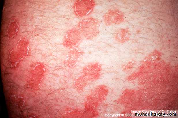 Fungal Infections