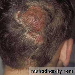 Fungal Infections