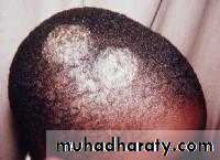 Fungal Infections