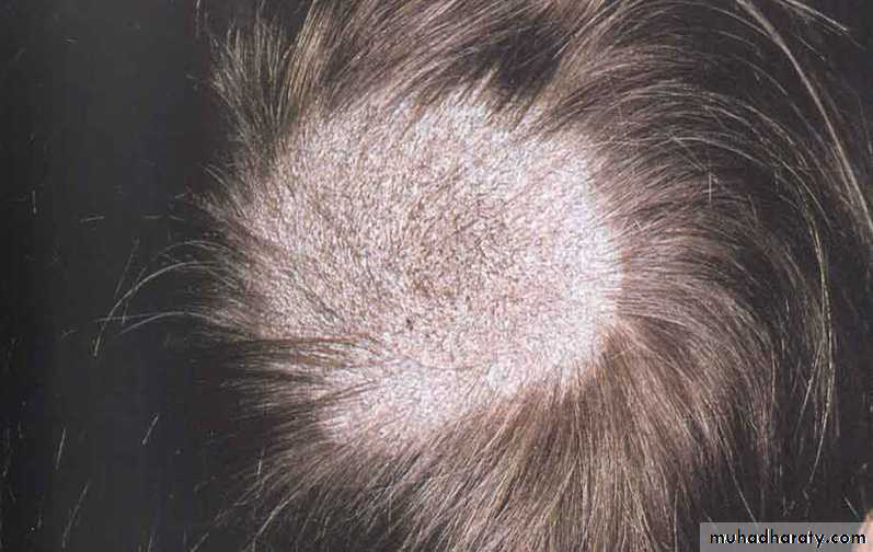 Fungal Infections