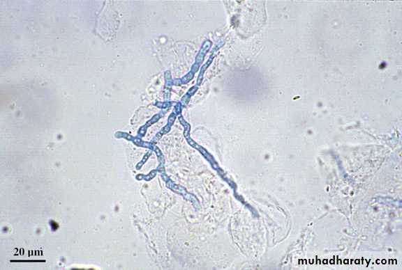 Fungal Infections