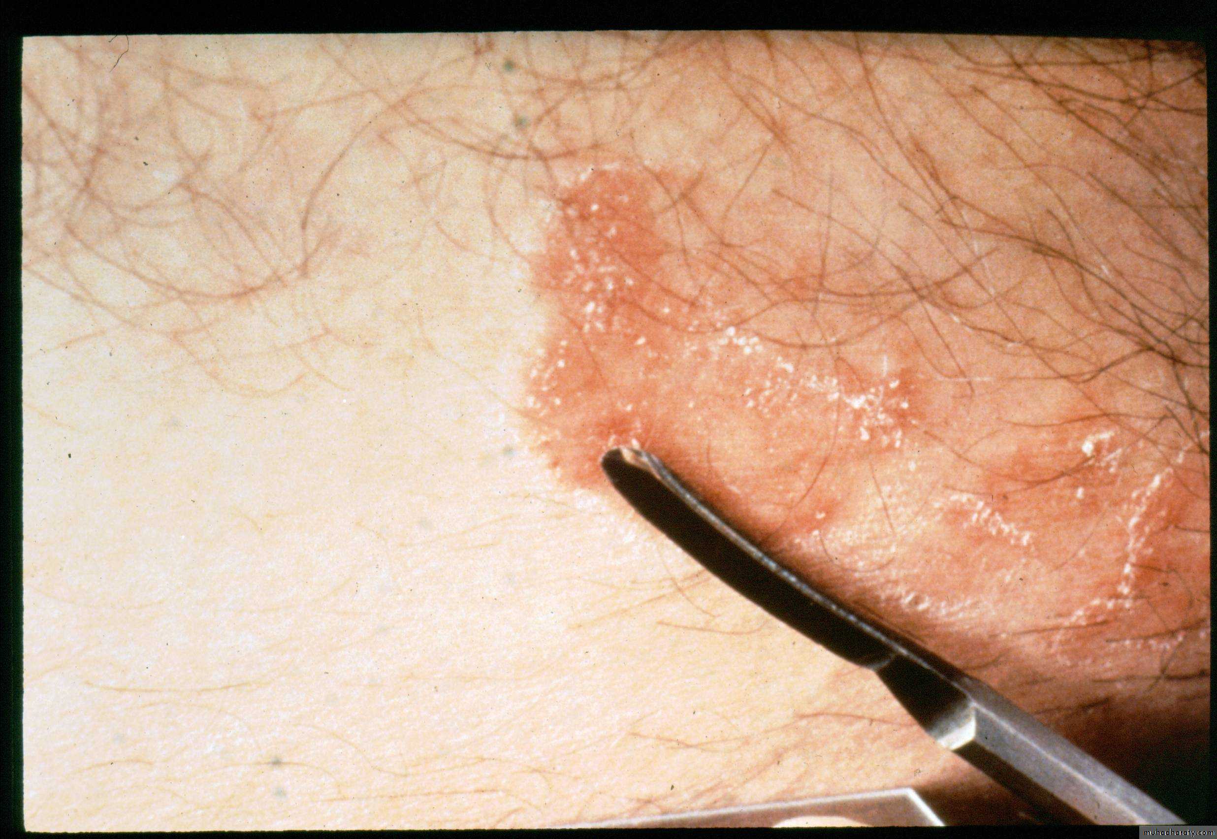 Fungal Infections
