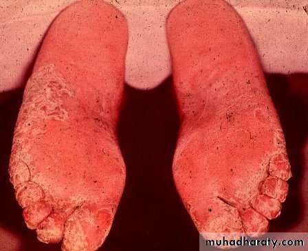 Fungal Infections