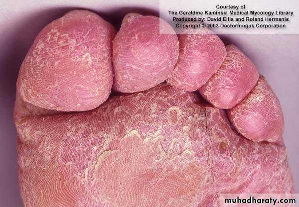 Fungal Infections