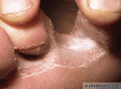 Fungal Infections
