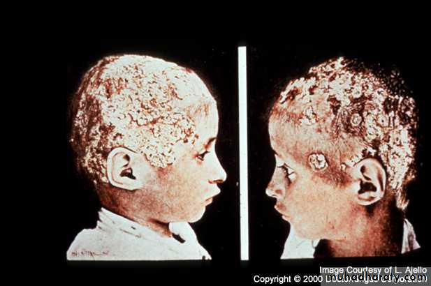 Fungal Infections