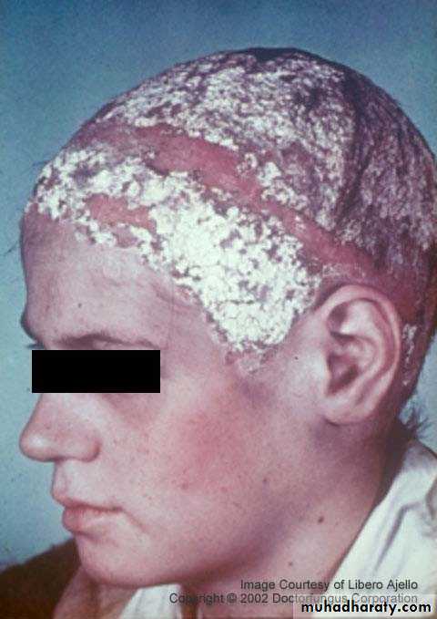 Fungal Infections