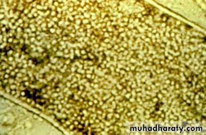 Fungal Infections