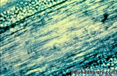 Fungal Infections