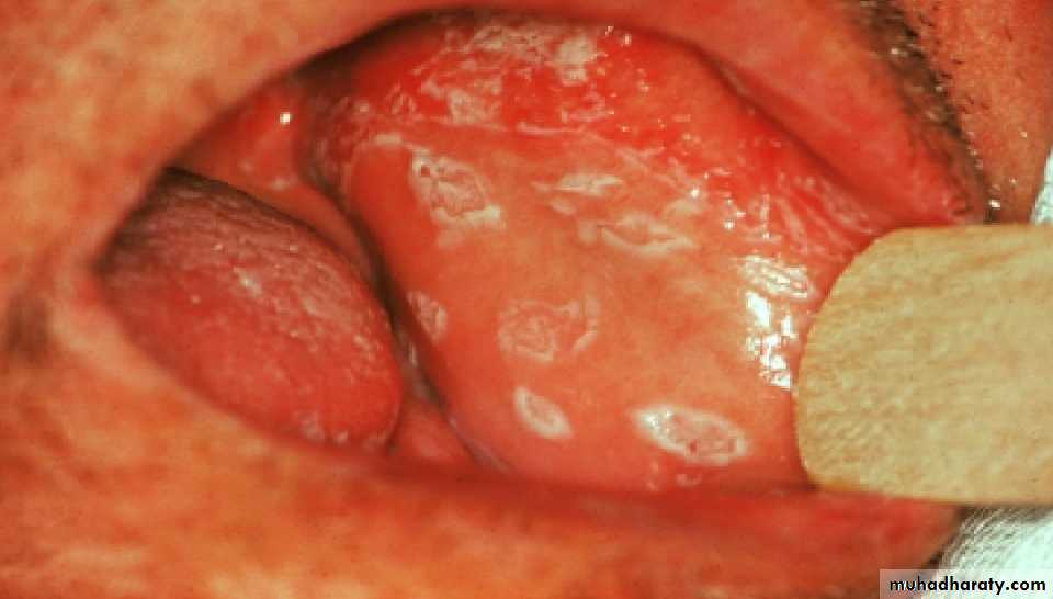Fungal Infections