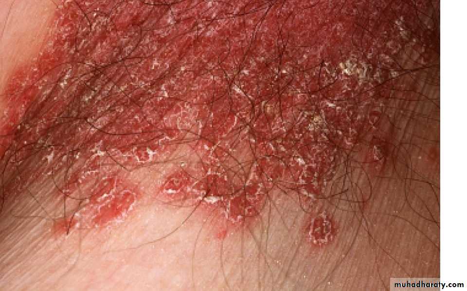 Fungal Infections