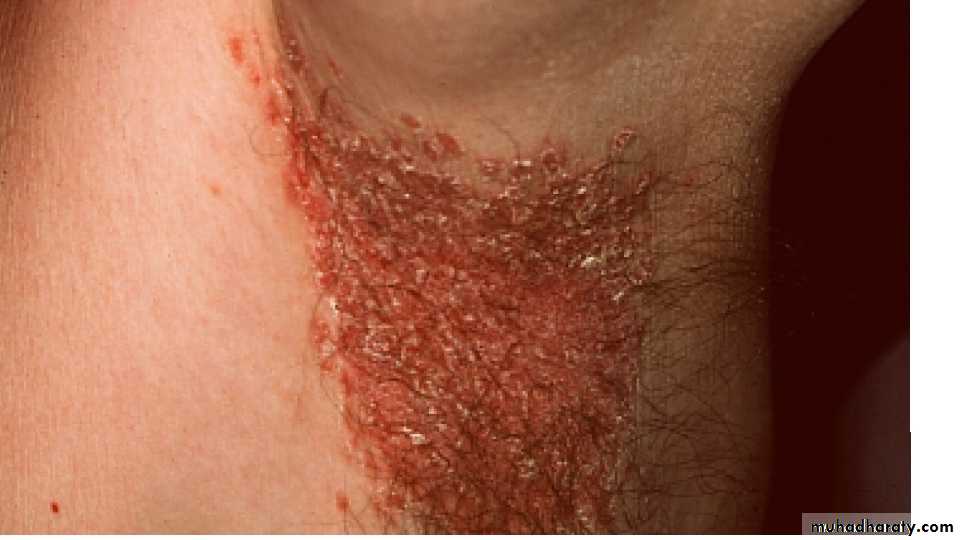 Fungal Infections