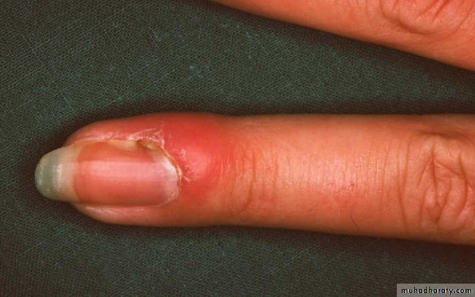 Fungal Infections